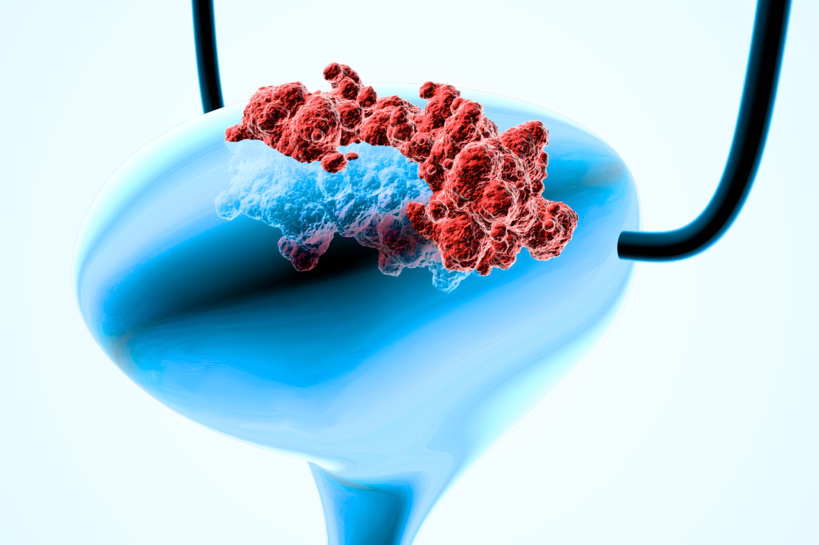 Urinary Bladder Cancer: Symptoms, Causes & Advanced Treatment