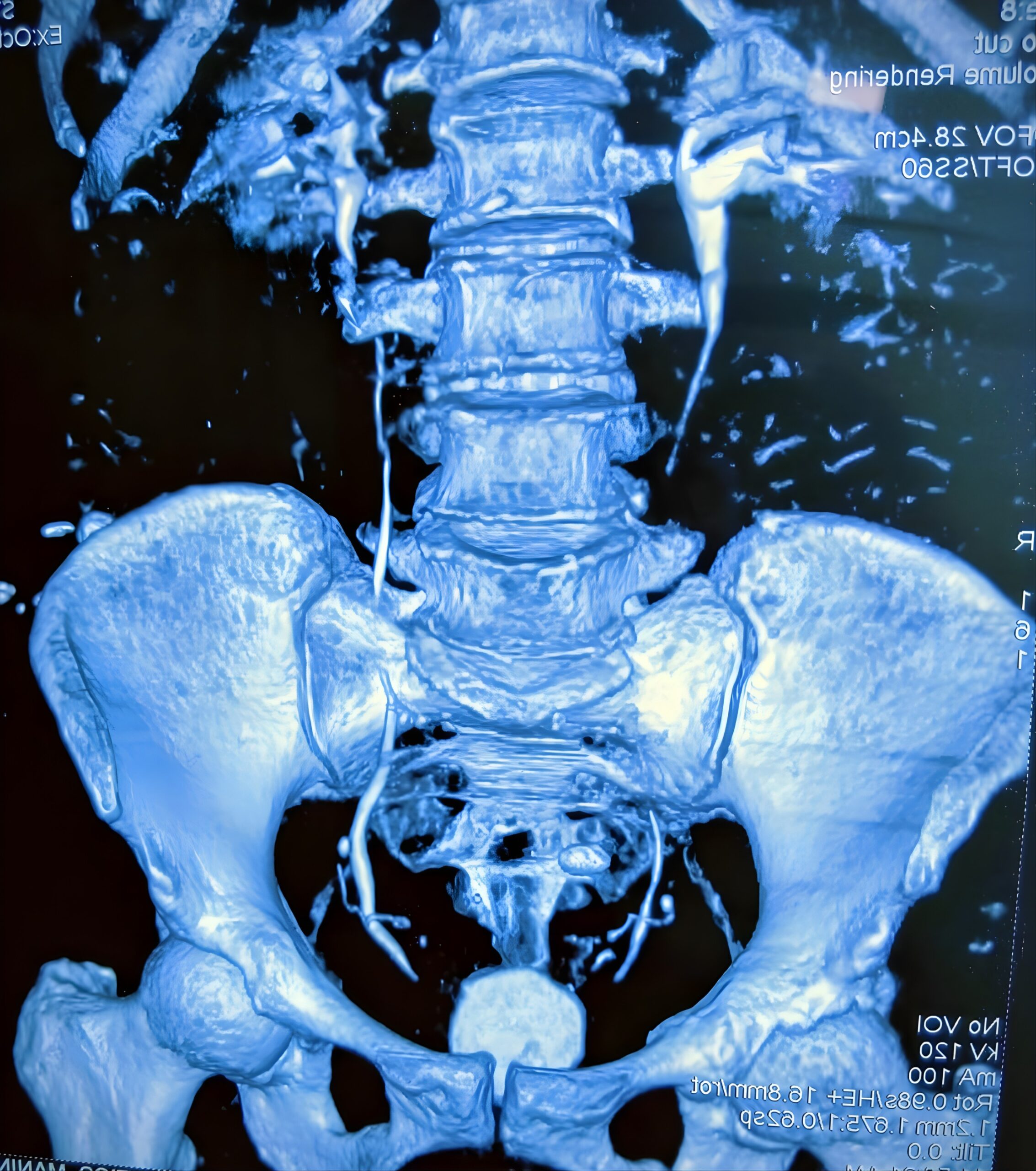 Case Study: Thimble Small-Capacity Urinary Bladder